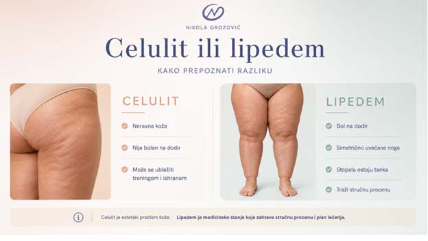 Razlika izmedju celulita i lipedema - Trener Nikola Orozović